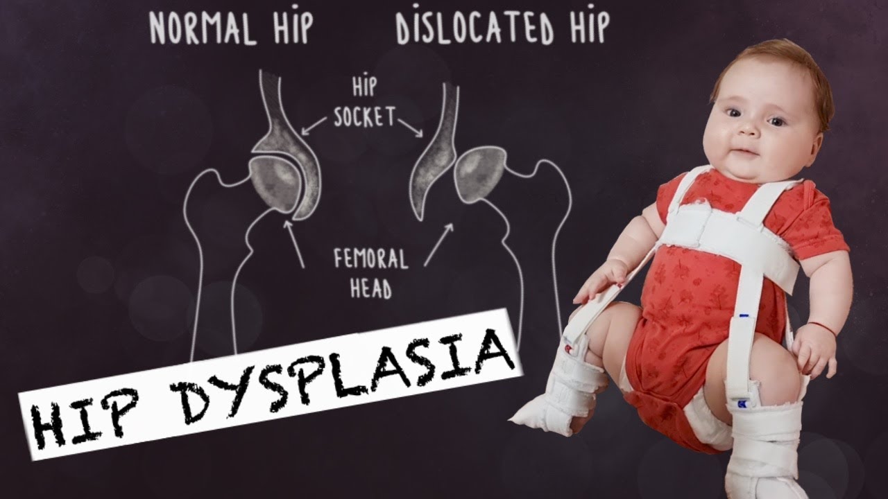 Our journey through Hip Dysplasia - Newborn to 4 months old