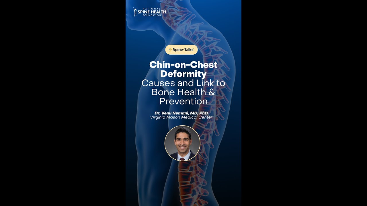 Chin-on-Chest Deformity&mdash; Causes, Link to Bone Health & Prevention
