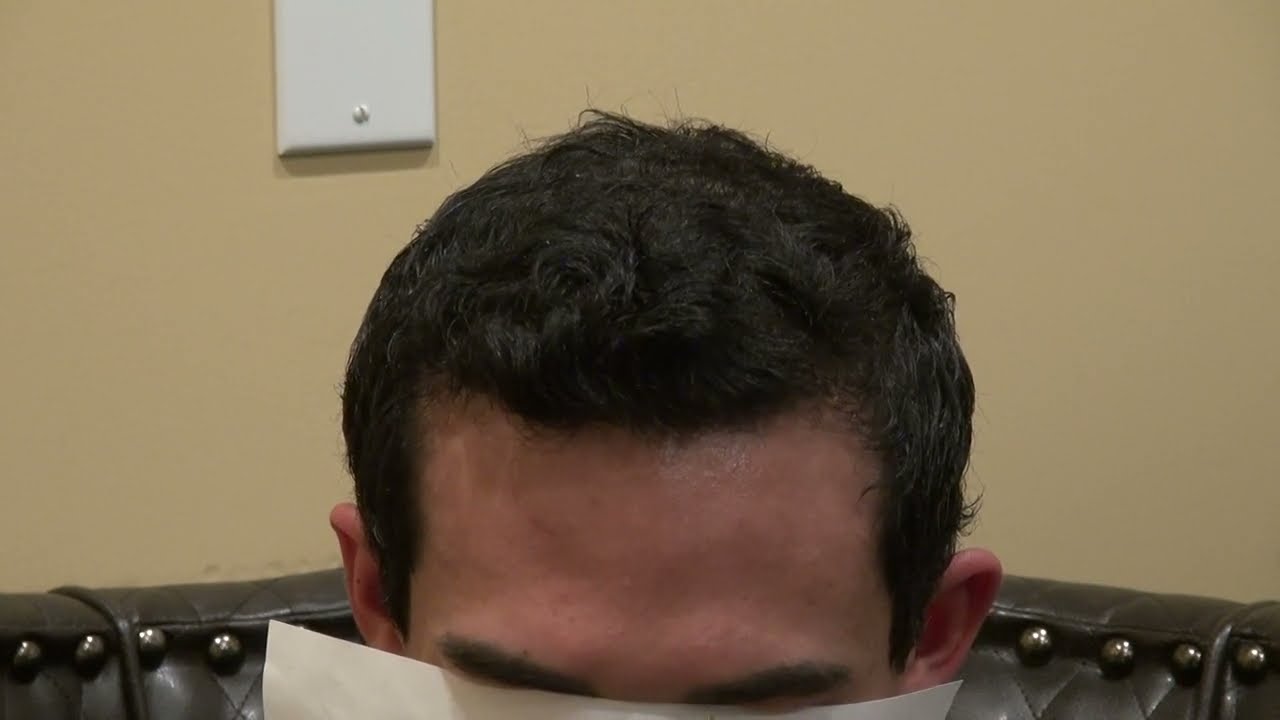 Top View Hair Transplant | Natural & Dense Result – Dr. John Diep