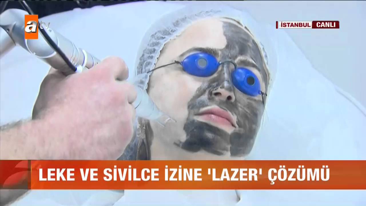 Leke ve sivilce izine lazer çözümü - atv Gün Ortası Bülteni