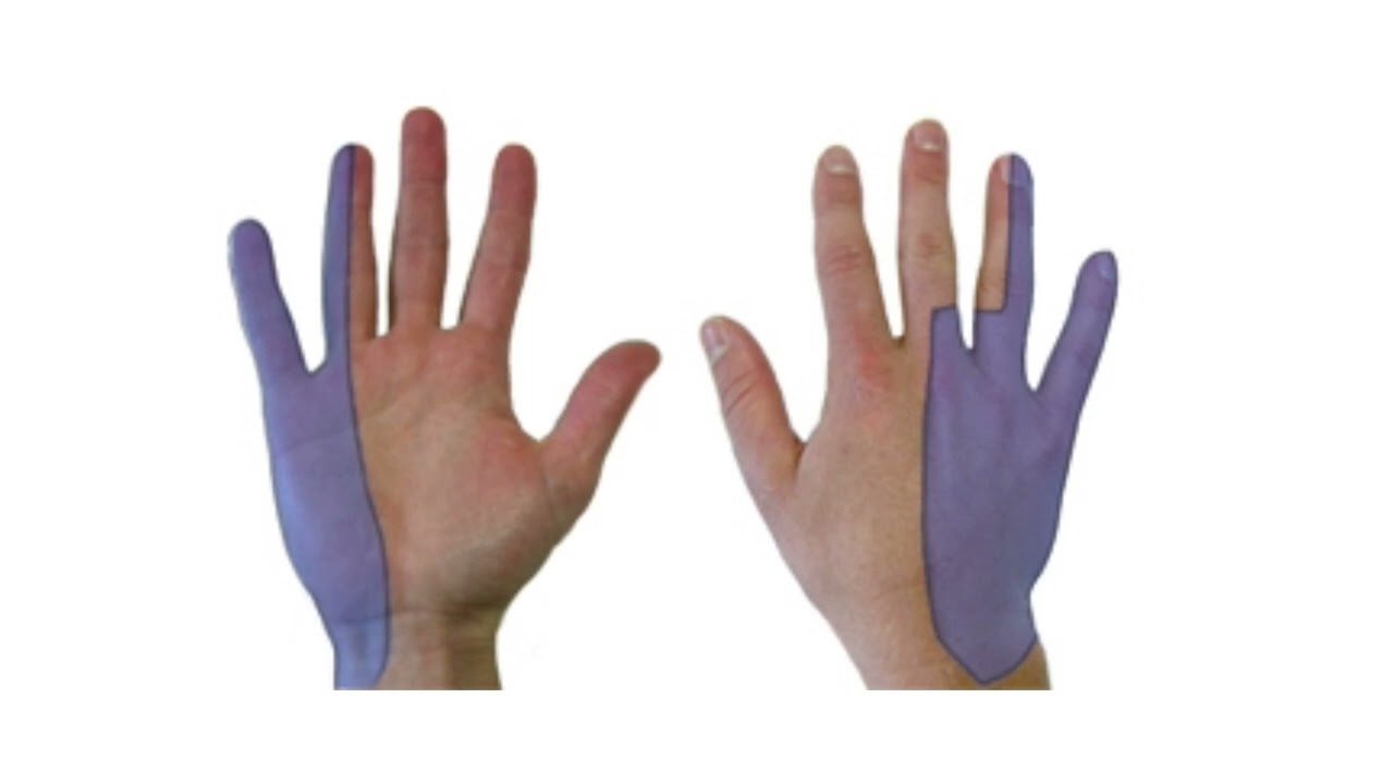 What is Guyon's Canal Syndrome
