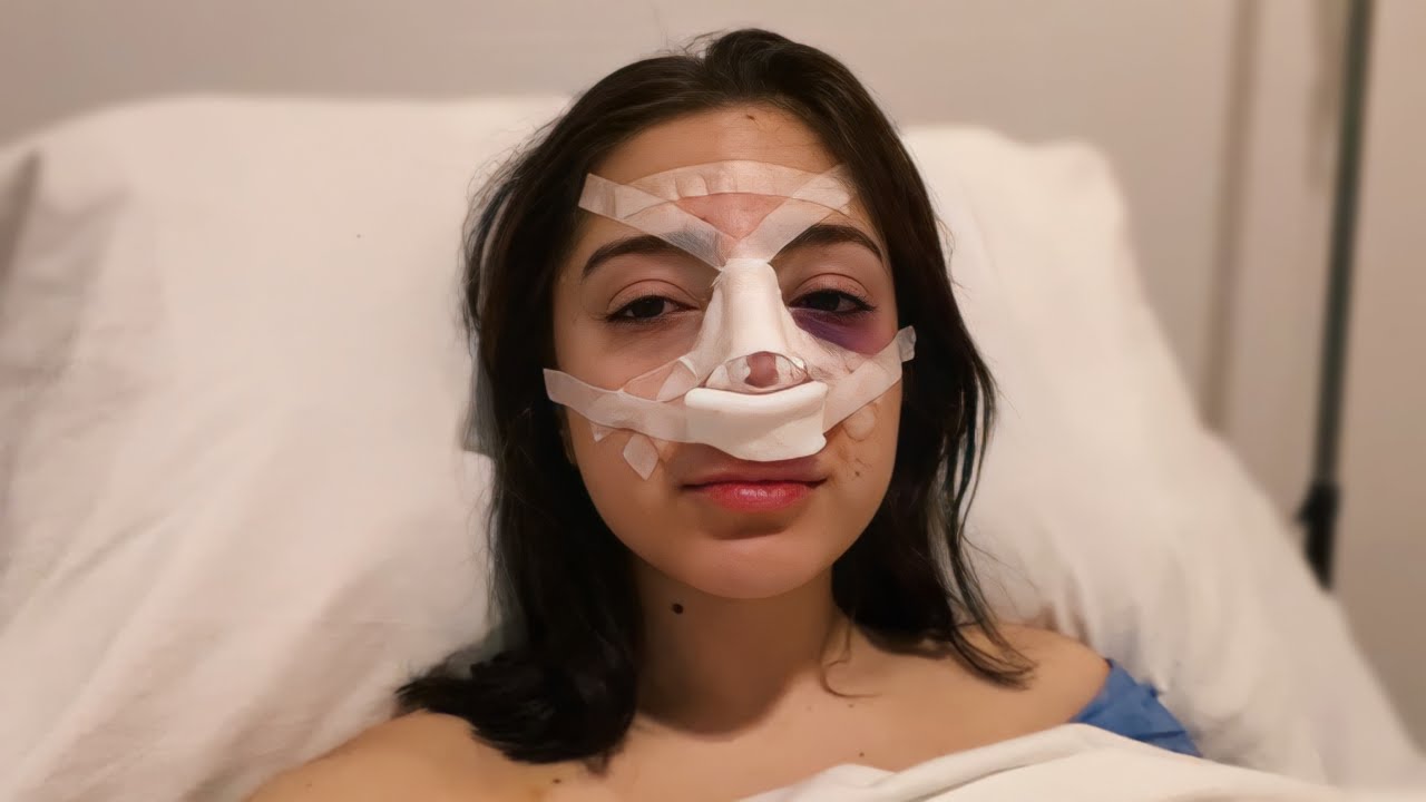 ME HICE UNA RINOPLASTIA