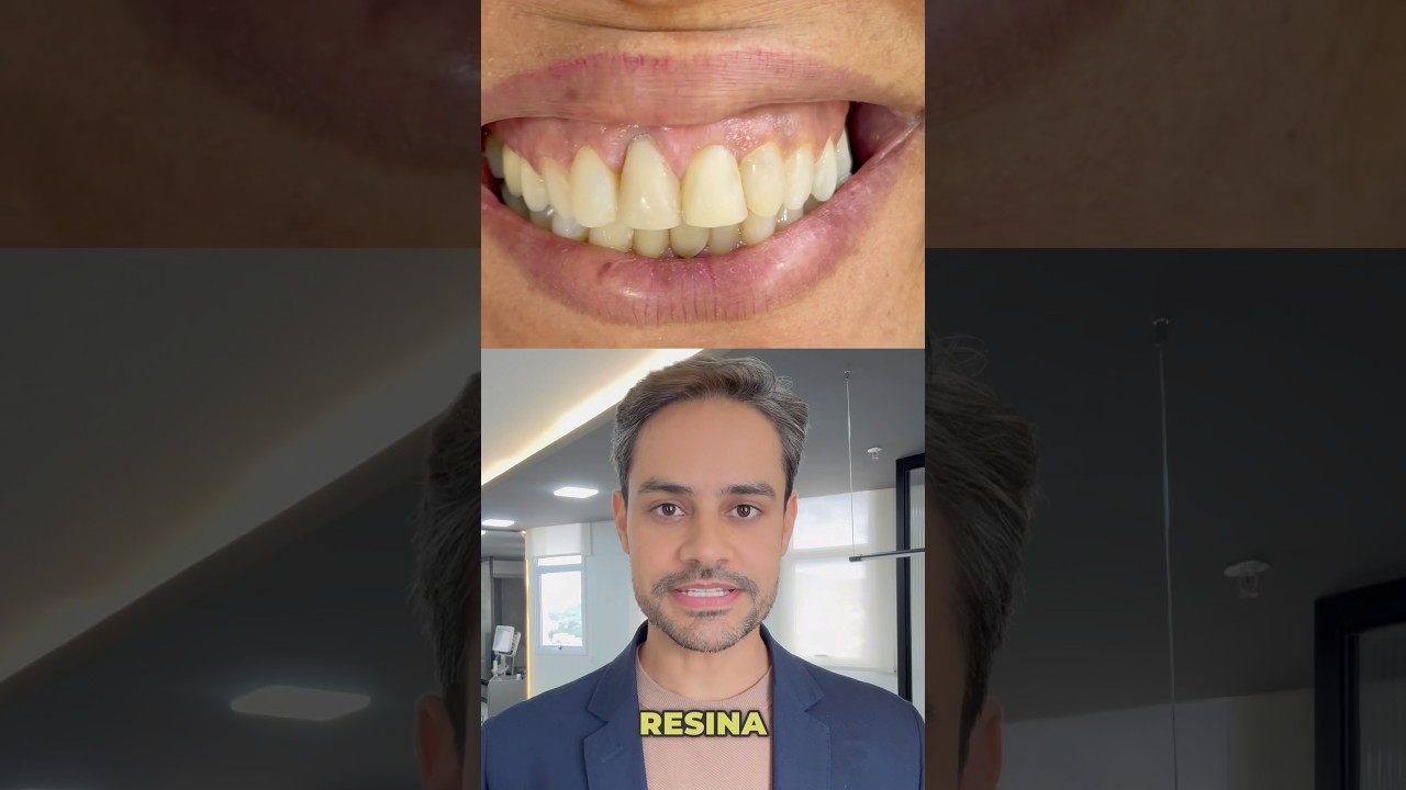 Resina em &aacute;rea de gengiva. #dentista #odontologia #ortodontia #sorriso #dentes #resinacomposta