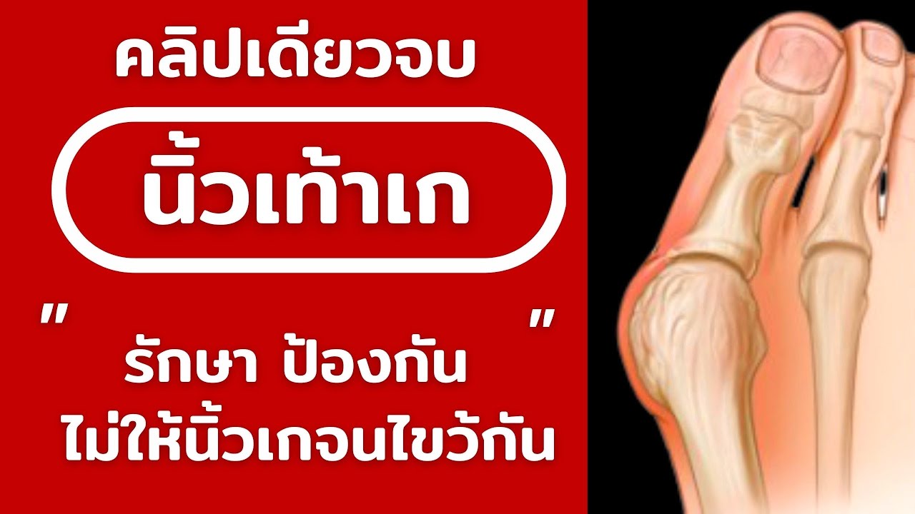นิ้วโป้งเท้าเก - รู้เรื่องวิธีการดูแล รักษา ป้องกัน เพื่อไม่ให้นิ้วเท้าเอียงมากขึ้น (คลิปเดียวจบ)