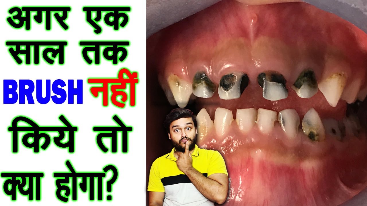 1 साल तक ब्रश नहीं किये तो क्या होगा? Hypothesis - What If You Don't Brush For 1 Year, TEF Ep 136
