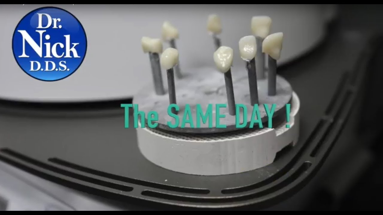 Same Day Cosmetic Veneers!  CADSMILES NWA - World Class Care