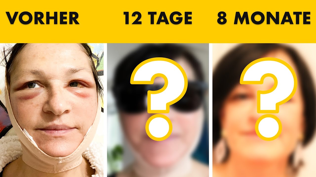 Facelift Patientin zeigt GESAMTEN Heilungsverlauf ungeschönt! | Dr. Jungwirth - Plastische Chirurgie