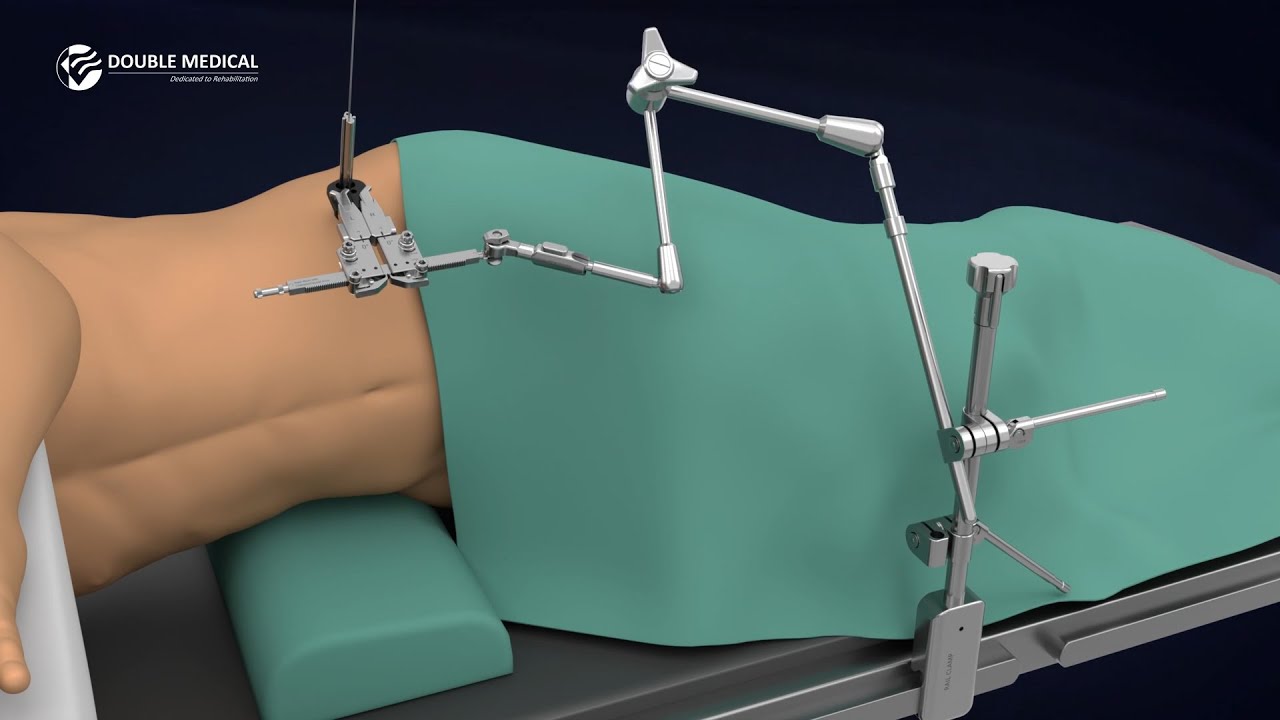 Revolutionize Spinal Surgery with MIS Anterolateral Spine Access System - Animated Guide
