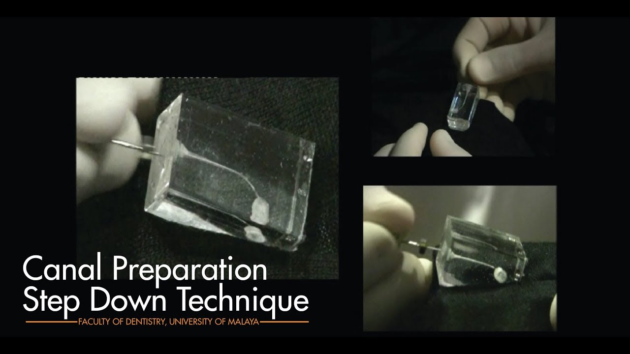 Canal Preparation Step Down Technique