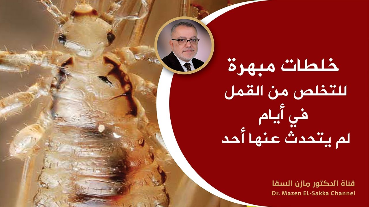 هل تعلم ماأسباب ظهور قمل شعر الرأس وأسهل طرق التخلص من القمل علاج القمل نهائيا بطرق طبيعية