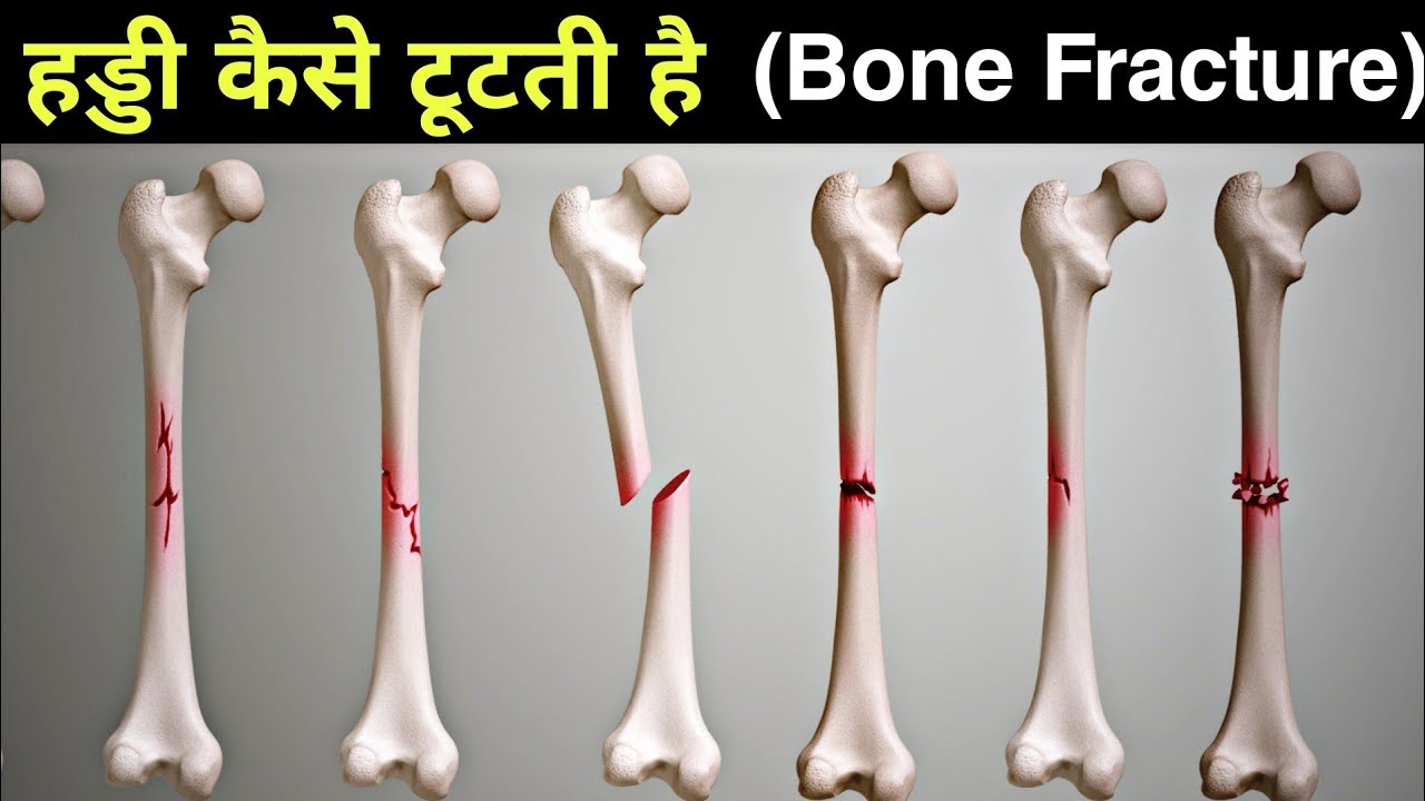 हड्डी कैसे टूट जाती हैं - types of bone fracture - 3D Animation