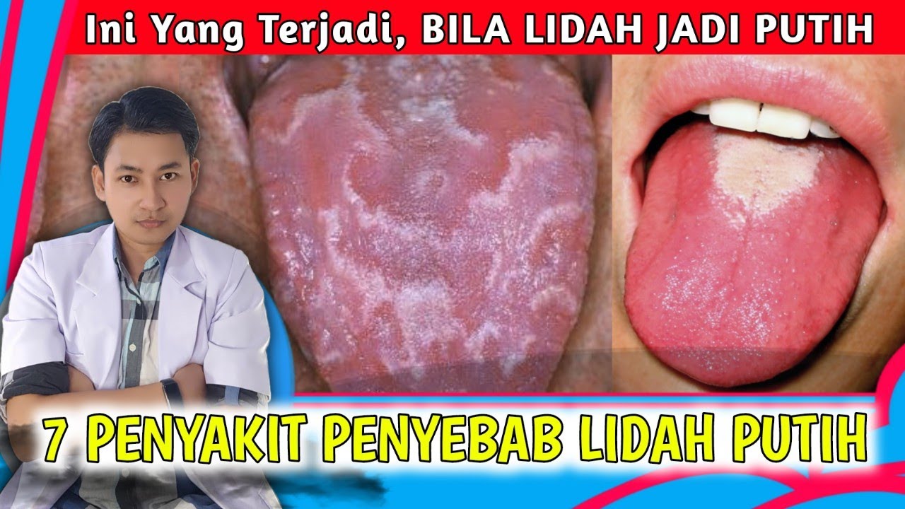 Mengapa Lidah Berwarna Putih? Begini Penyebab dan Cara mengatasinya || dr. Andi