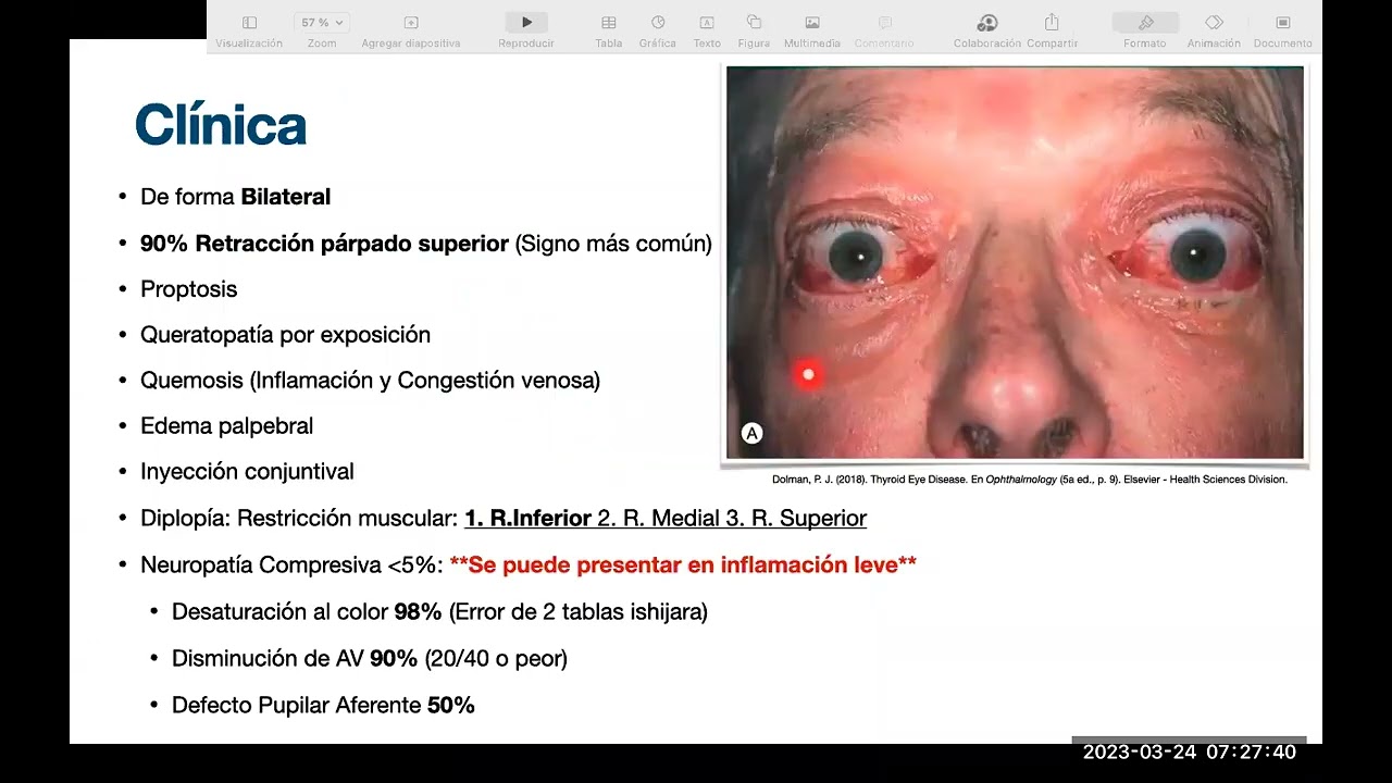 Orbitopatía Tiroidea. Dr Daniel Gonzaléz. 2023_03_24