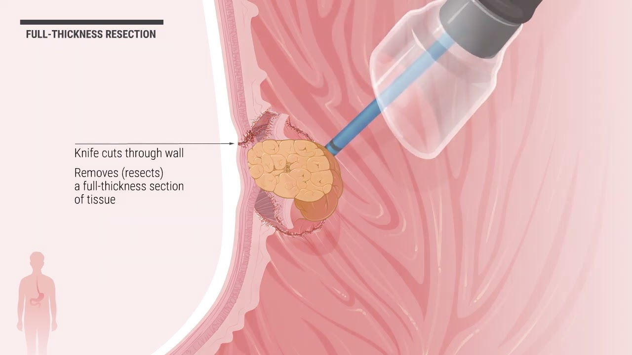 Endoscopic Full Thickness Resection