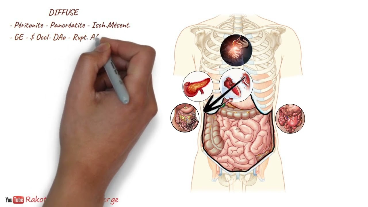 OD : DOULEUR ABDOMINALE AIGUË DE L'ADULTE (l'essentiel) - Première partie : Clinique