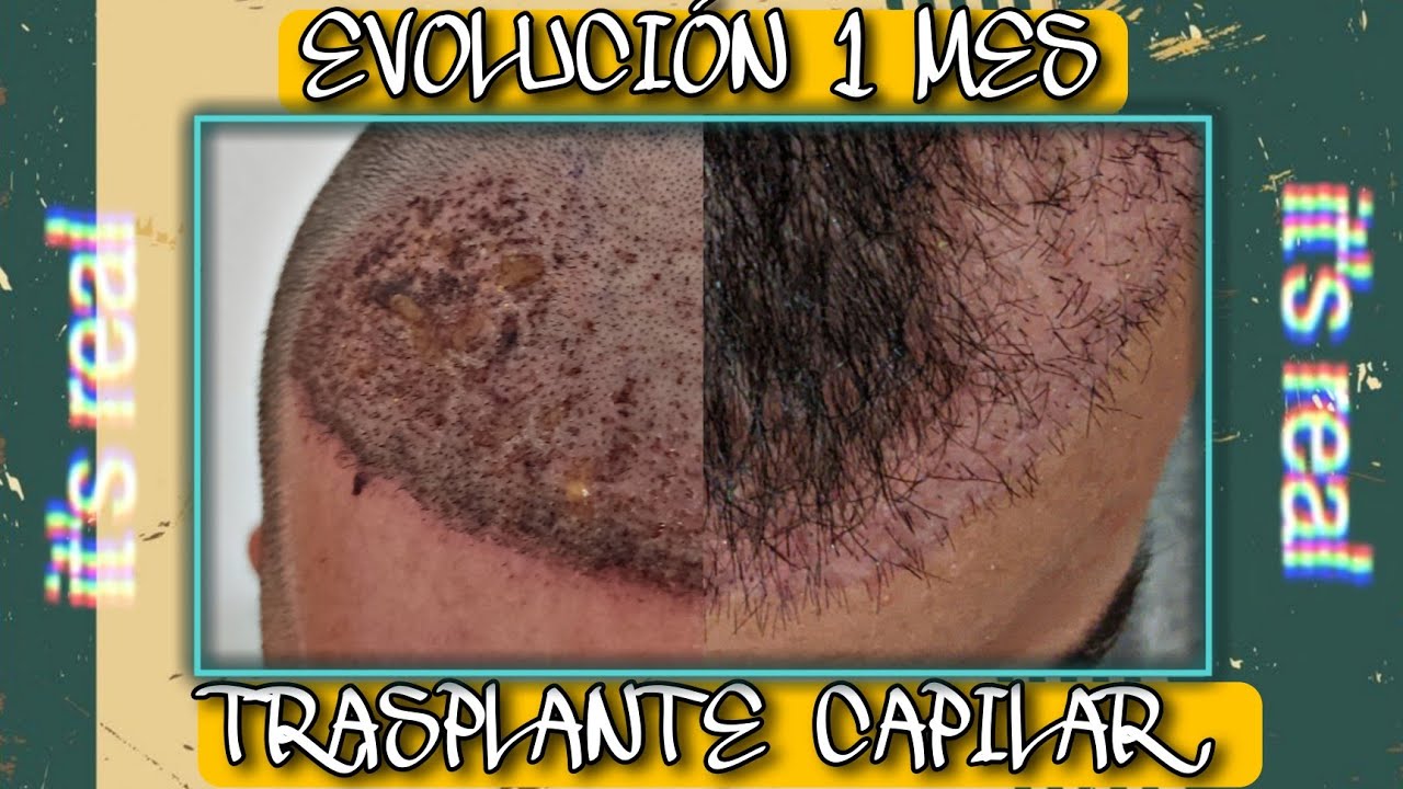 #16.-Evolución TRASPLANTE CAPILAR 1 MES