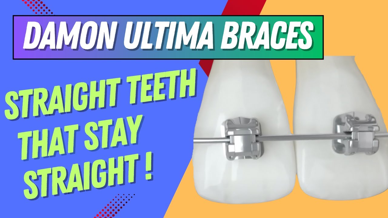 Damon Ultima: Straight Teeth That Stay Straight !