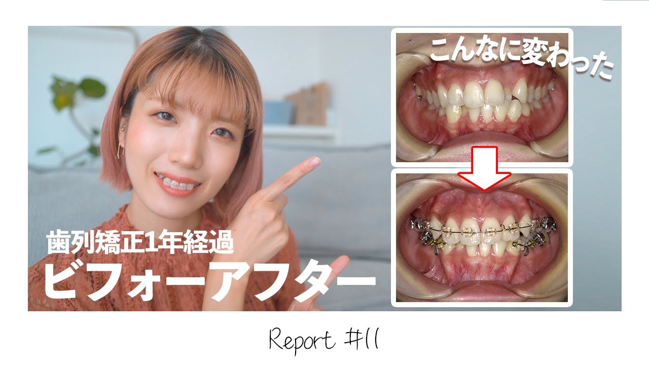 【歯列矯正】1年経過!歯並びの変化ビフォーアフター/現在の歯の痛み【表側ワイヤー矯正】