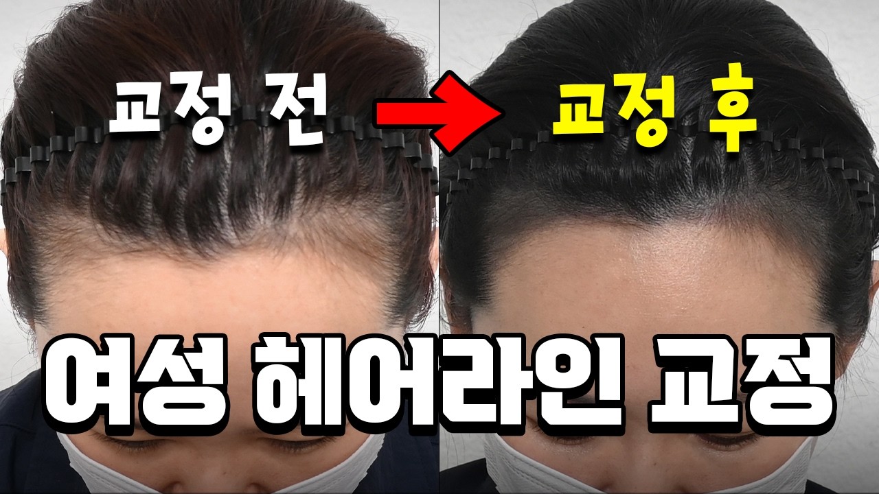 40대 넓은 헤어라인 고민? 이거 하나로 반전!
