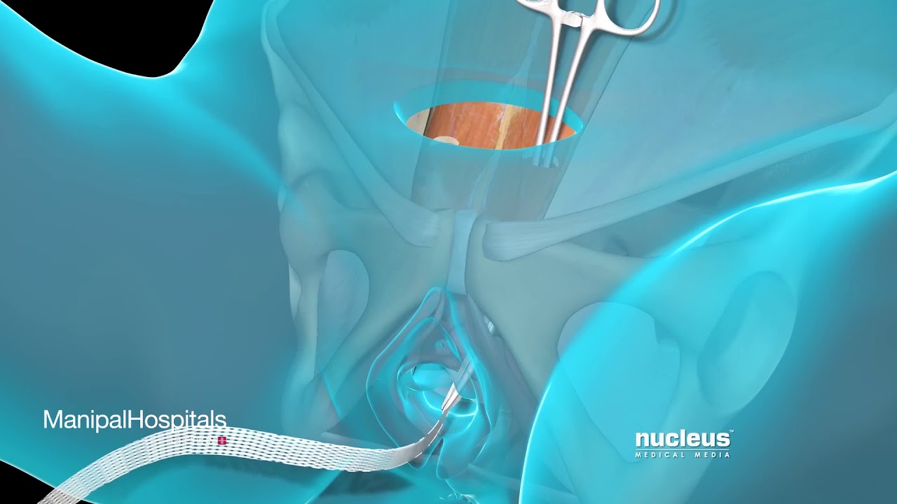 Stress Urinary Incontinence | Leakage of Urine | Stress Incontinence - Manipal Hospitals
