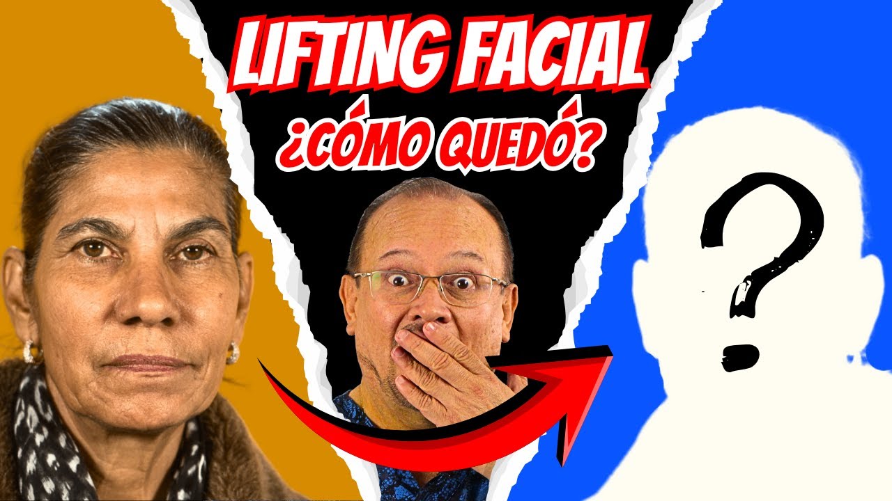 Lleg&oacute; desde Rep&uacute;blica Dominicana para rejuvenecer su rostro. Aqu&iacute; el resultado!
