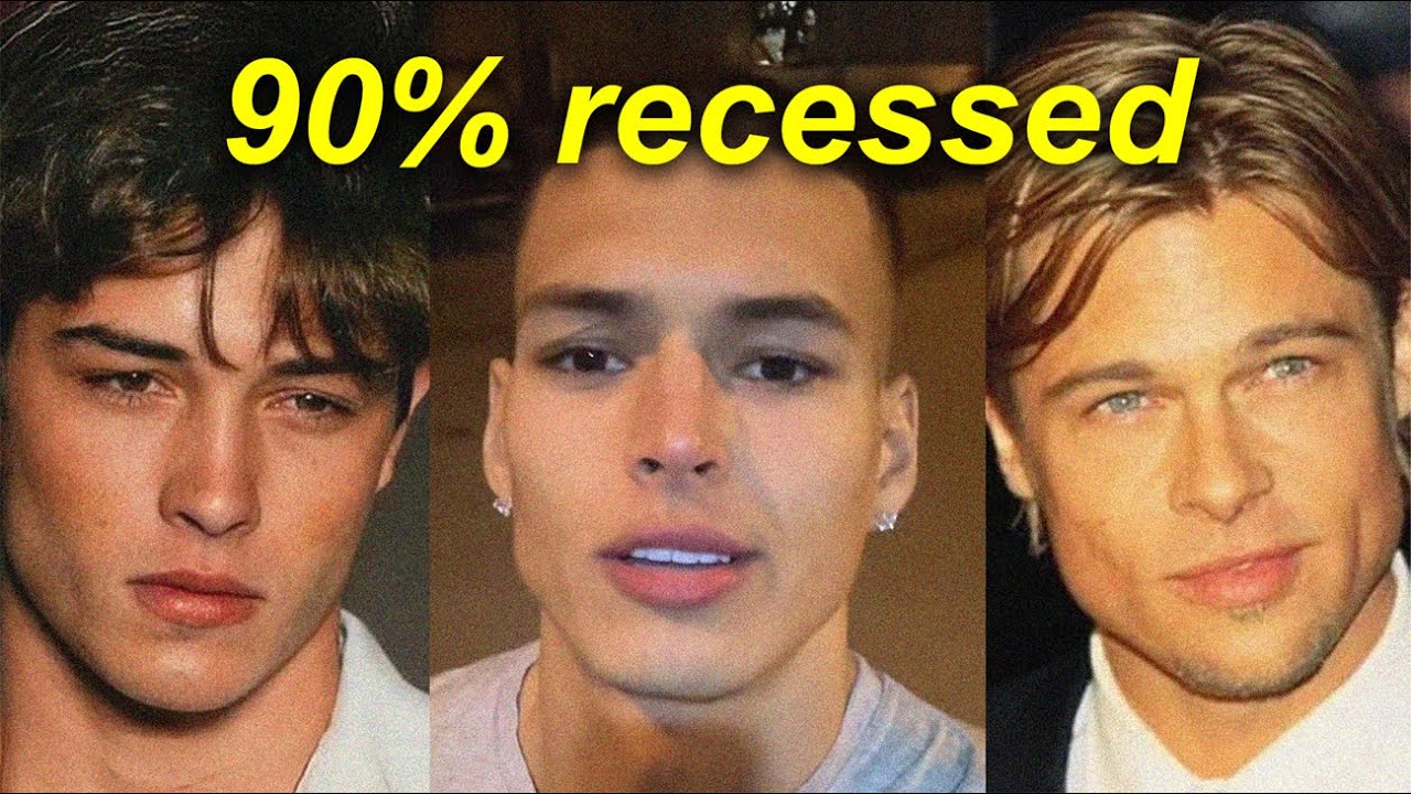 Attractive CELEBRITIES With RECESSED MAXILLA