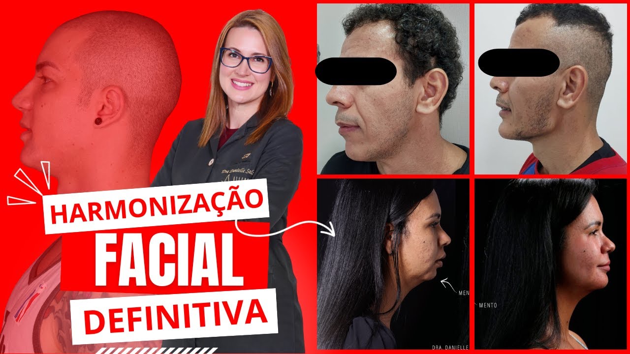 Harmonização Facial Definitiva - Próteses Faciais customizadas - Dra . Danielle Sales