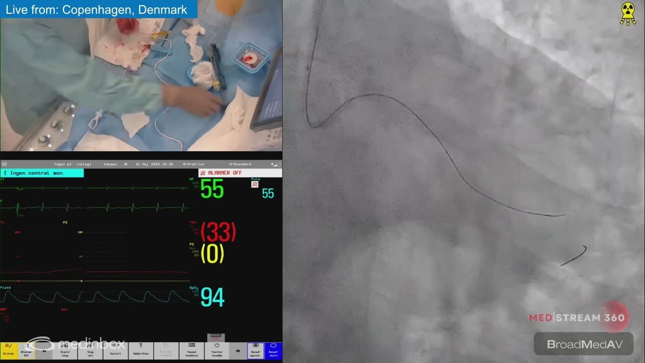 PCI of LCX CTO Using Antegrade Approach