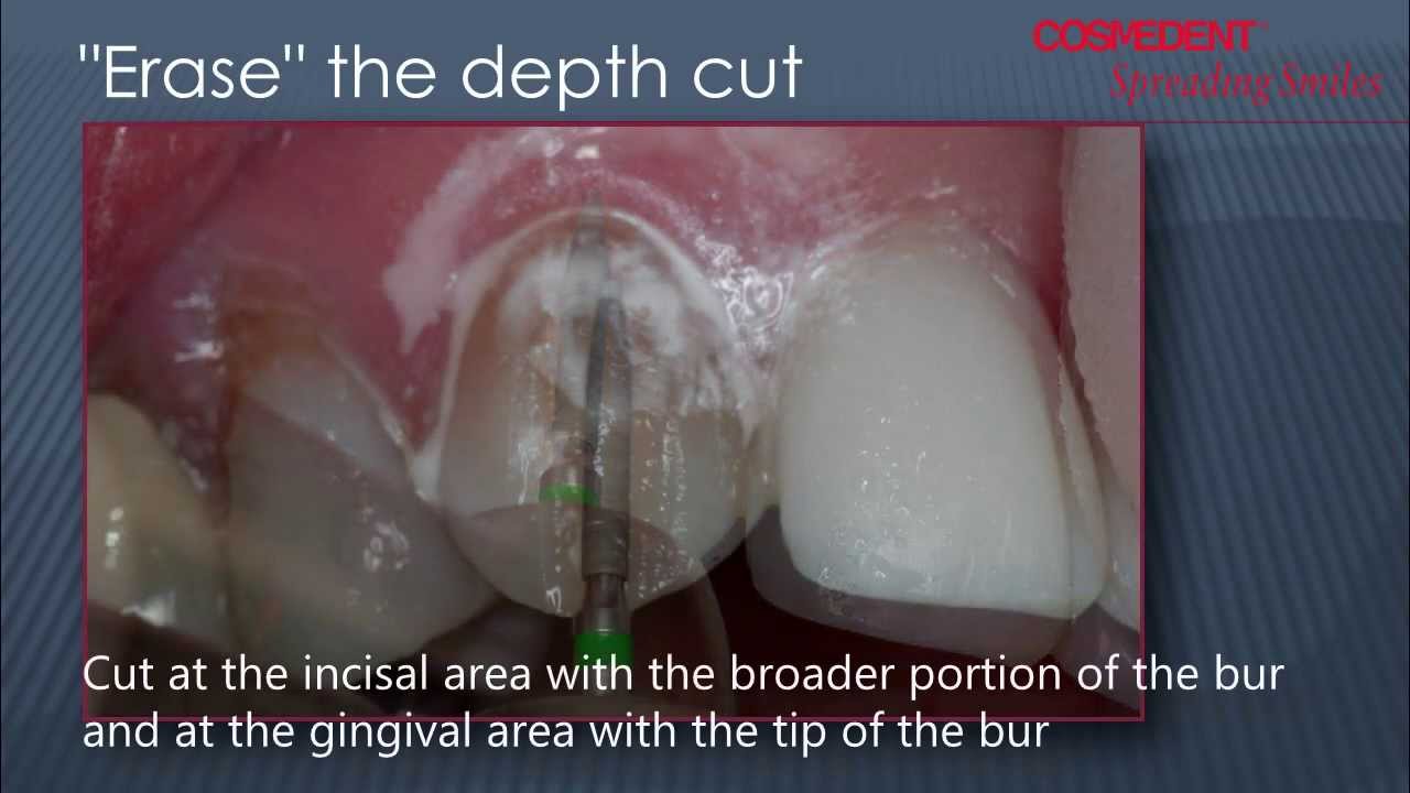 Composite Veneers Preparation