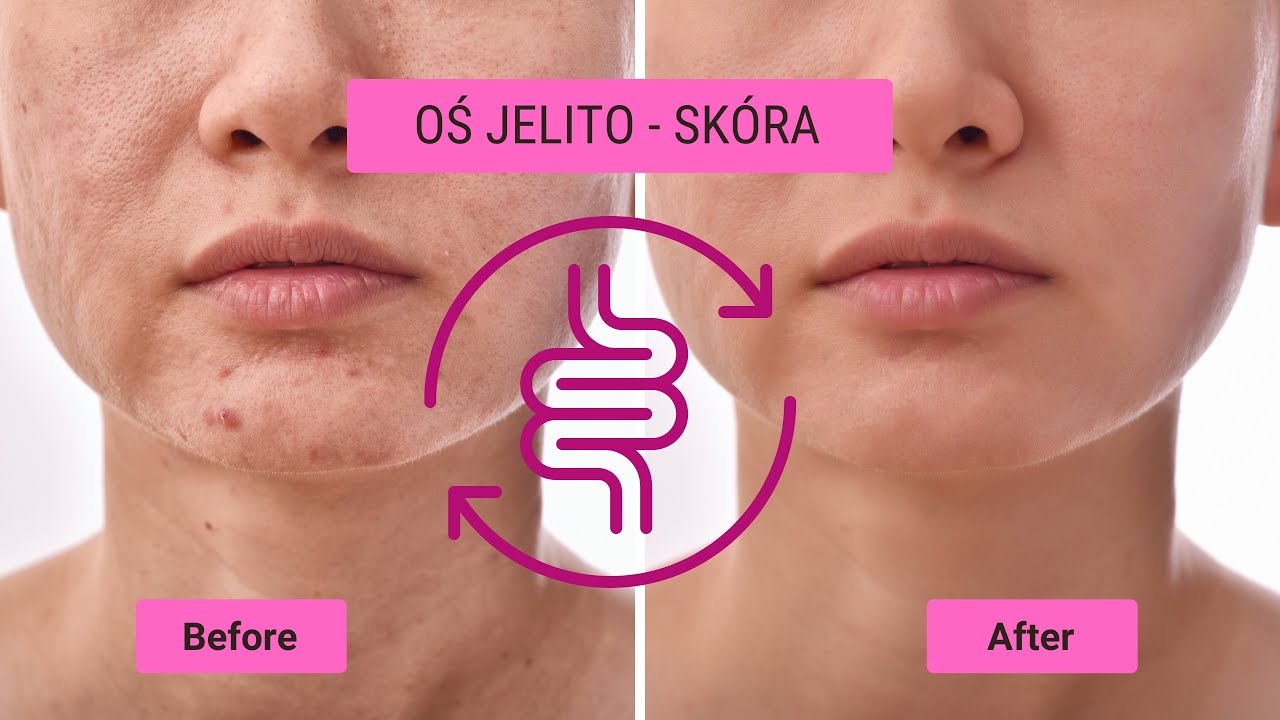 Problemy sk&oacute;rne? Przyjrzyj się jelitom! | dr Patrycja Szachta