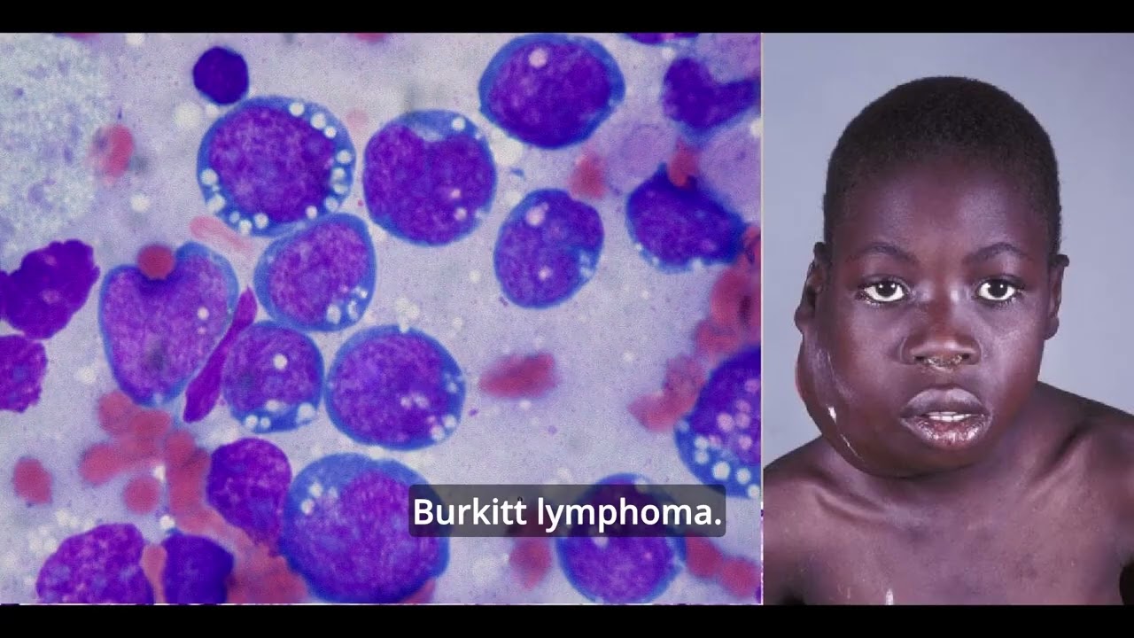 Handbook on Diffuse Large B-Cell Lymphoma | Dr Amit Shah, Haematology-Oncologist |part-1| MDforLives