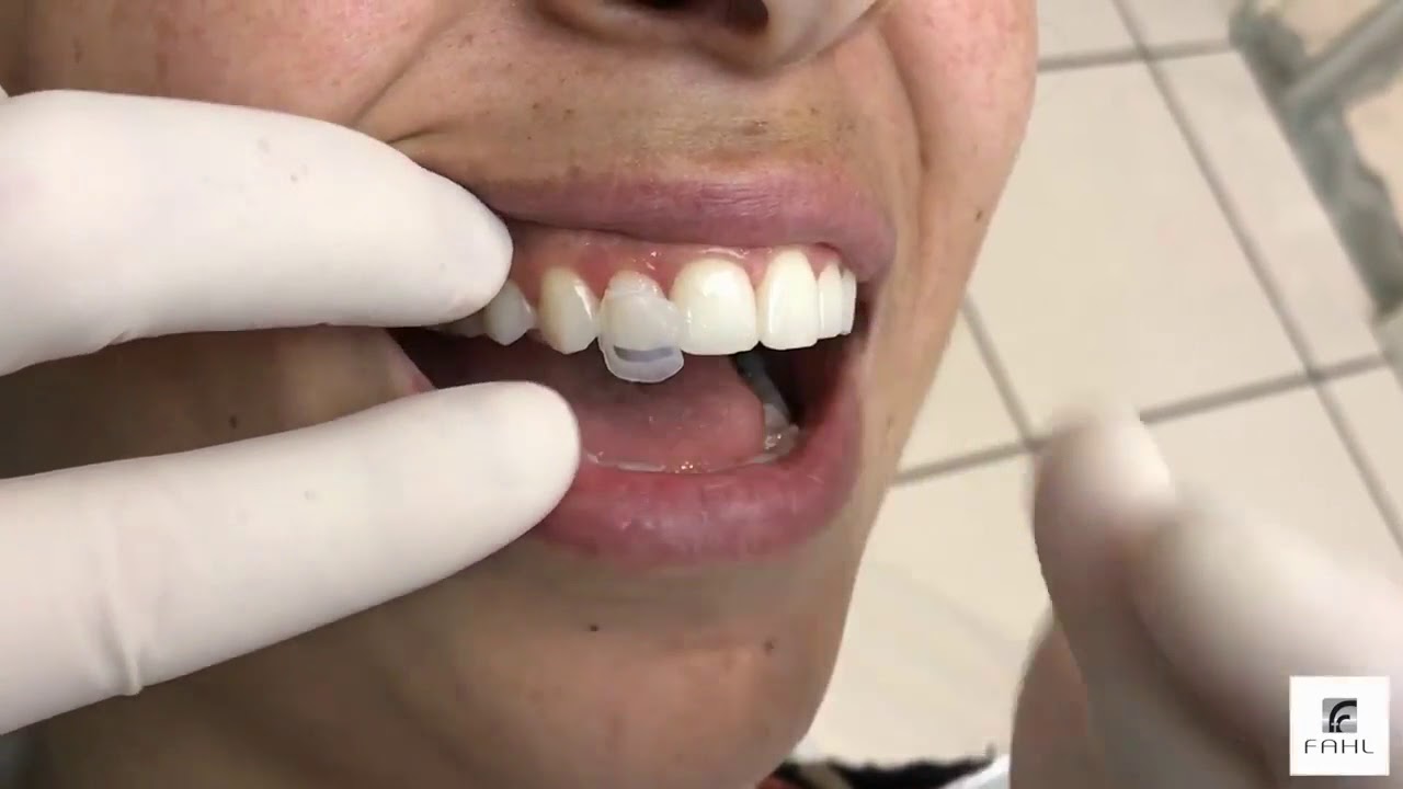 Dr  Newton Fahl uses Uveneer Composite Veneer System