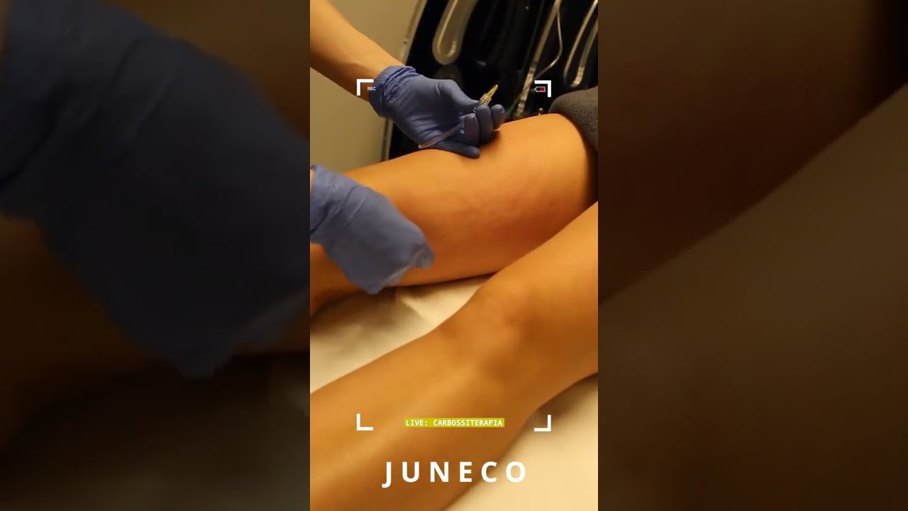 Carbossiterapia: per il trattamento di cellulite e adiposità localizzata