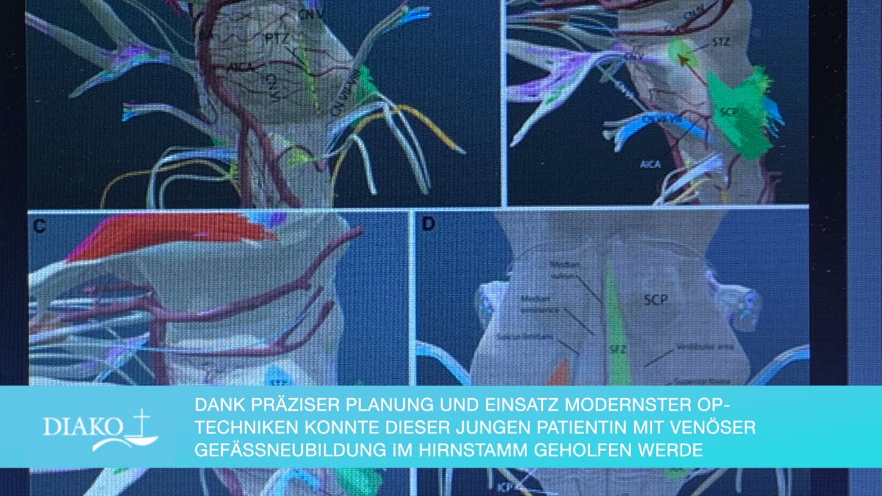 Erfolgreiche OP eines Hirnstamm-Cavernoms in Flensburg mit 4K und 3D: Neurochirurgie in Flensburg.
