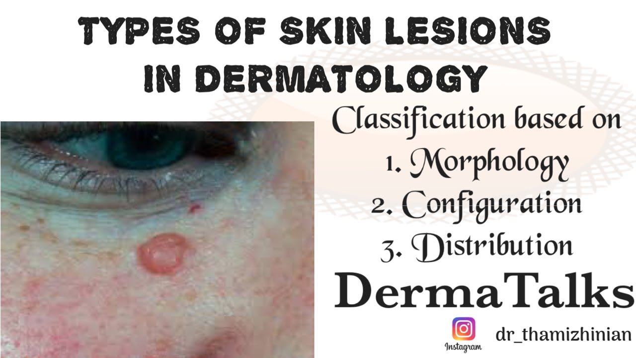 #Educationalvideo TERMS IN DERMATOLOGY || TYPES OF LESIONS|| Dr Thamizhinian || DermaTalks
