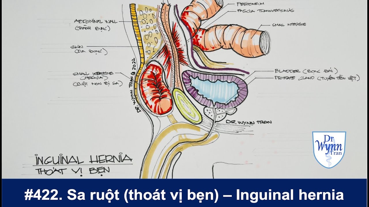 #422. Bệnh sa ruột (thoát vị bẹn) triệu chứng, chữa trị, và cách ngăn ngừa