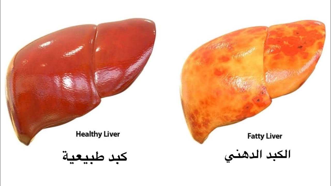 الكبد الدهني: الأسباب والعلاج 