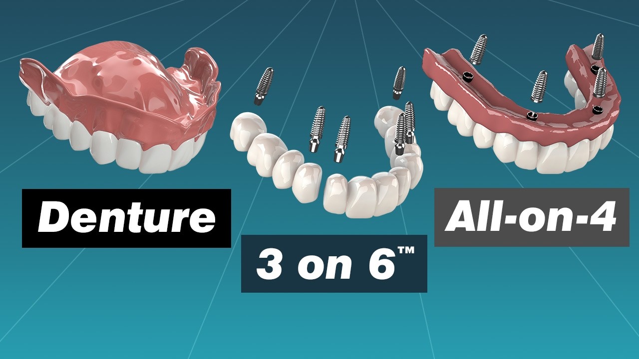 Alternative to Dentures: Comparing Dentures, Overdentures, All-on-4 and 3 on 6™