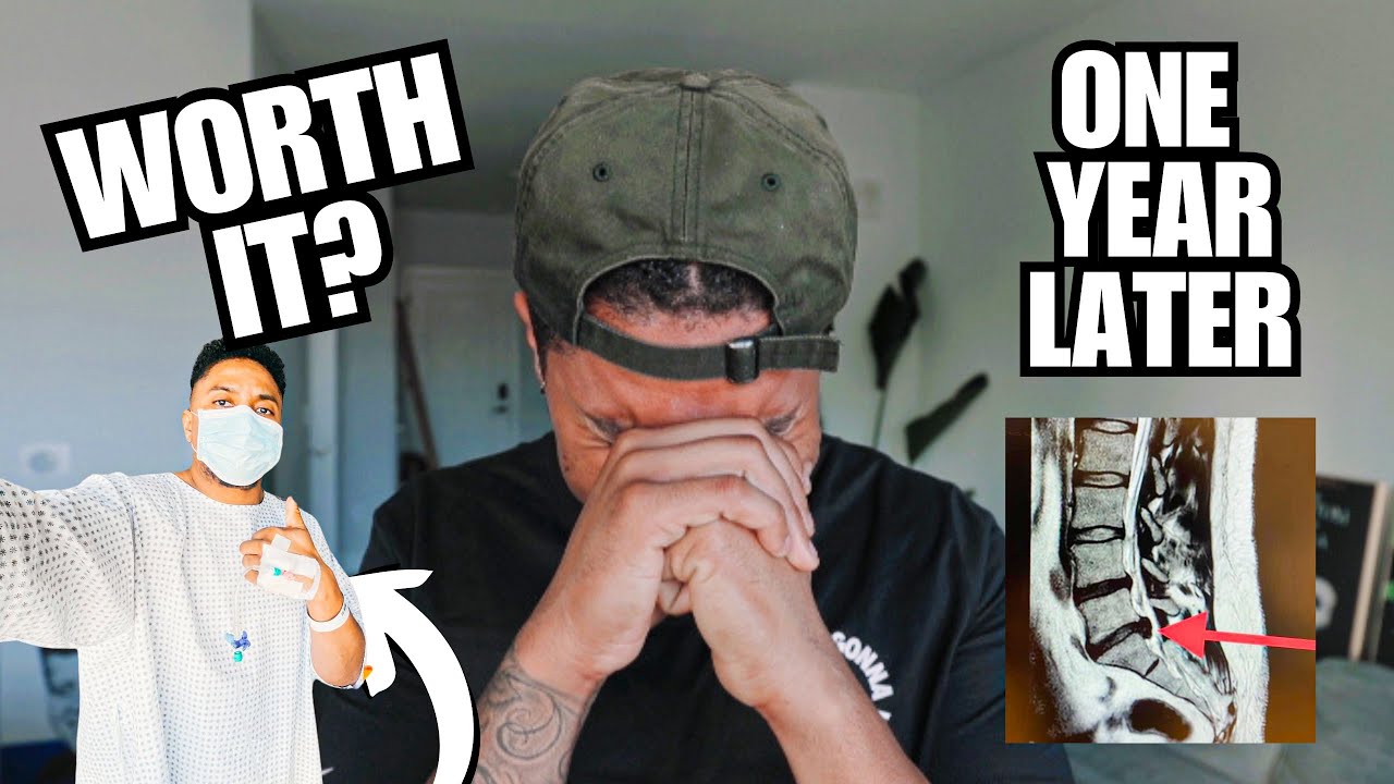 ONE YEAR LATER...WAS MY SPINE SURGERY WORTH IT? (MY L5/S1 MICRODISCECTOMY RECOVERY EXPERIENCE)