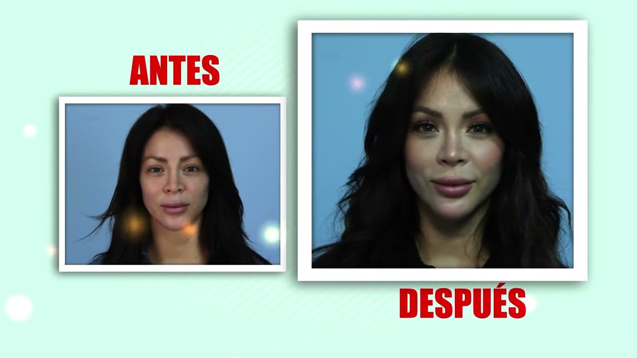 RINOPLASTÍA RECONSTRUTIVA de SHEYLA ROJAS  🤩 LA SHEY en Medicina Extraordinaria 🤩 DR ALBERTO CALVO