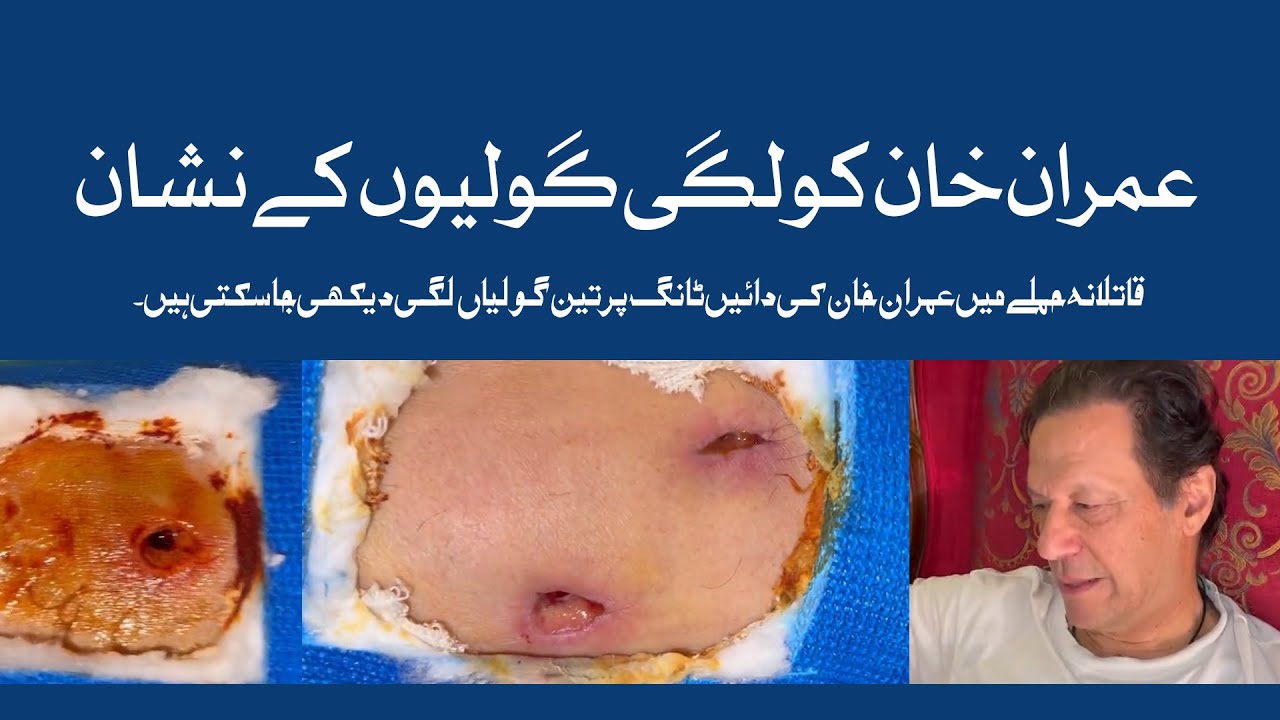 Imran Khan injury wounds video | Imran Khan Kay Zakhmon Ki Video