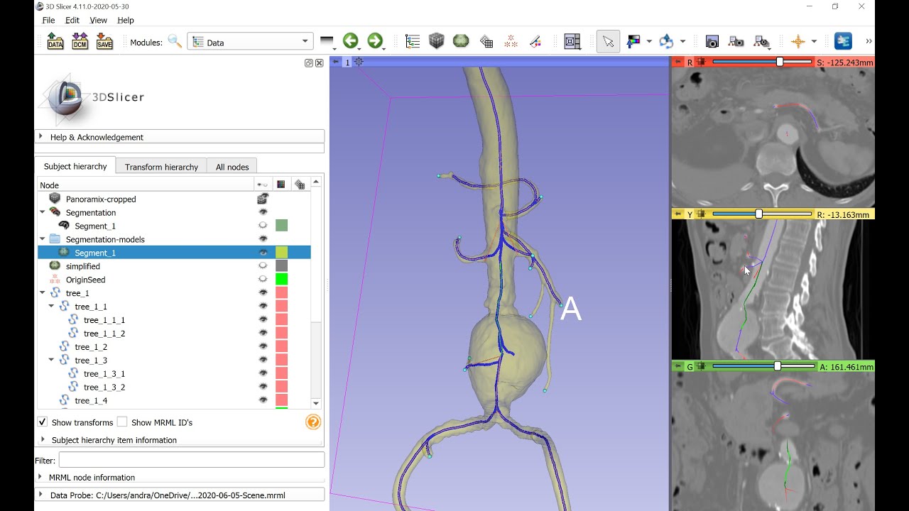 Vessel segmentation and centerline extraction using 3D Slicer and VMTK