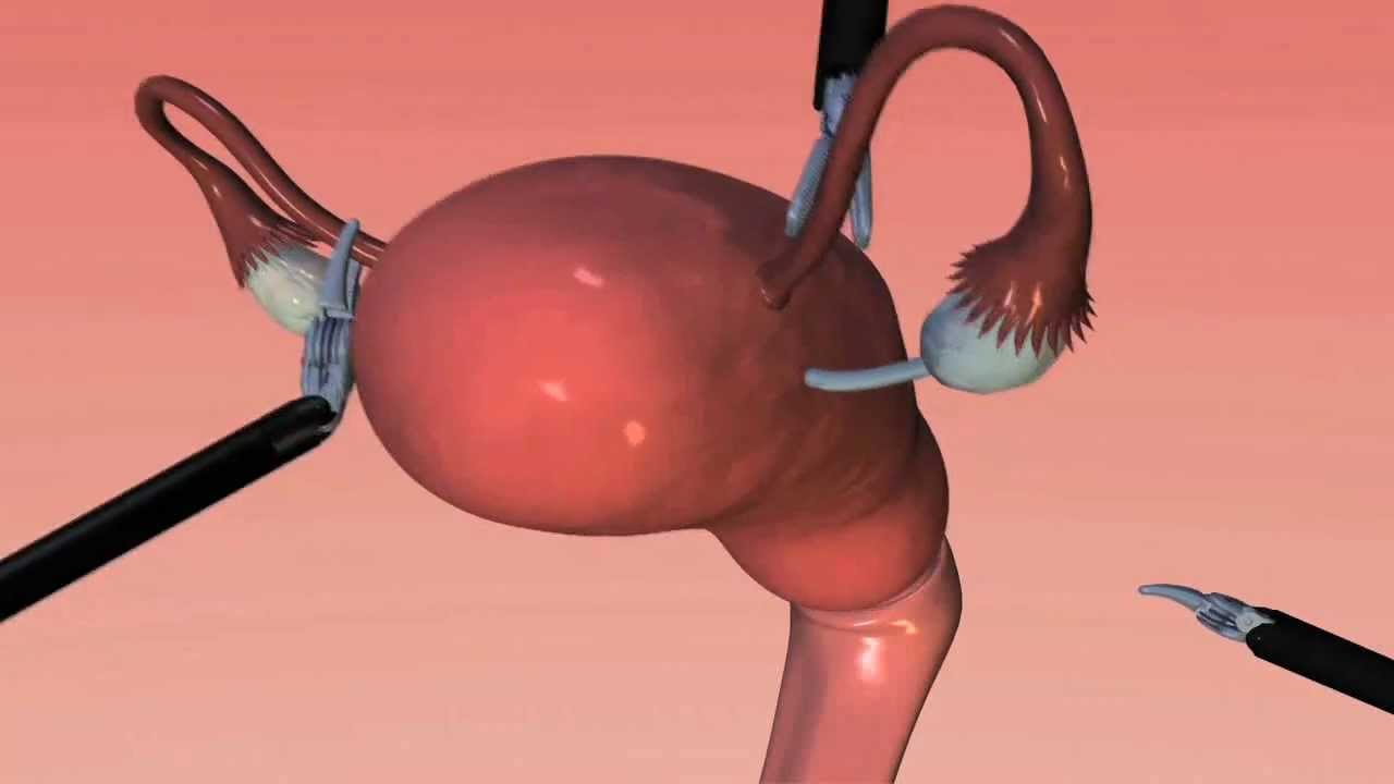 How is robotic surgery performed?