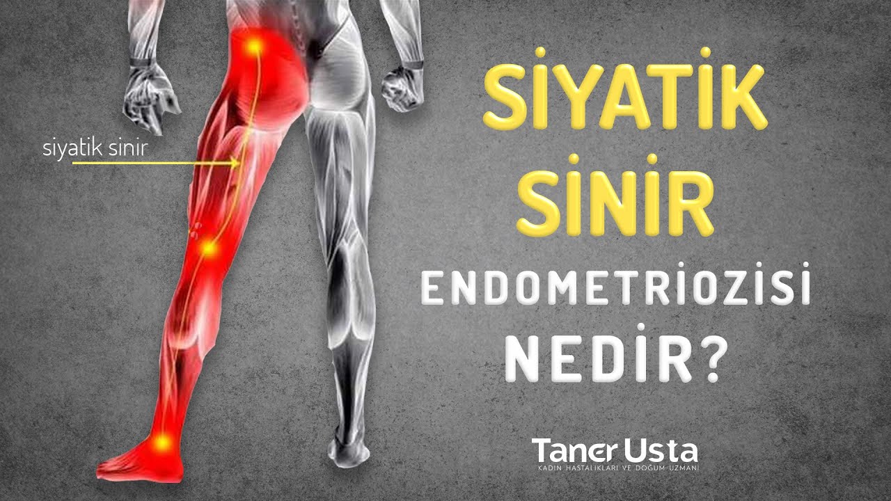 Siyatik Sinir Endometriozisi | Prof. Dr. Taner Usta