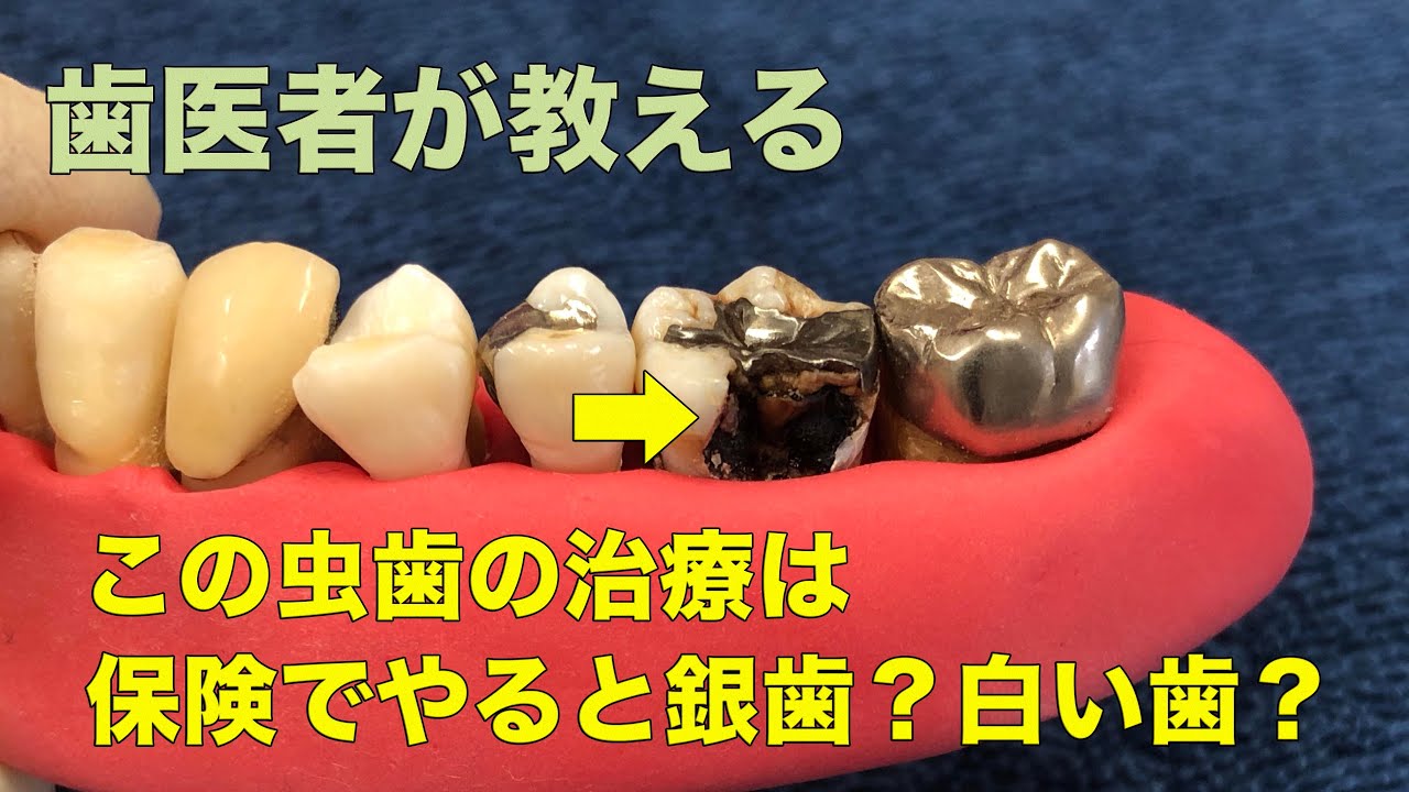 この虫歯の治療法は銀歯？白い歯？