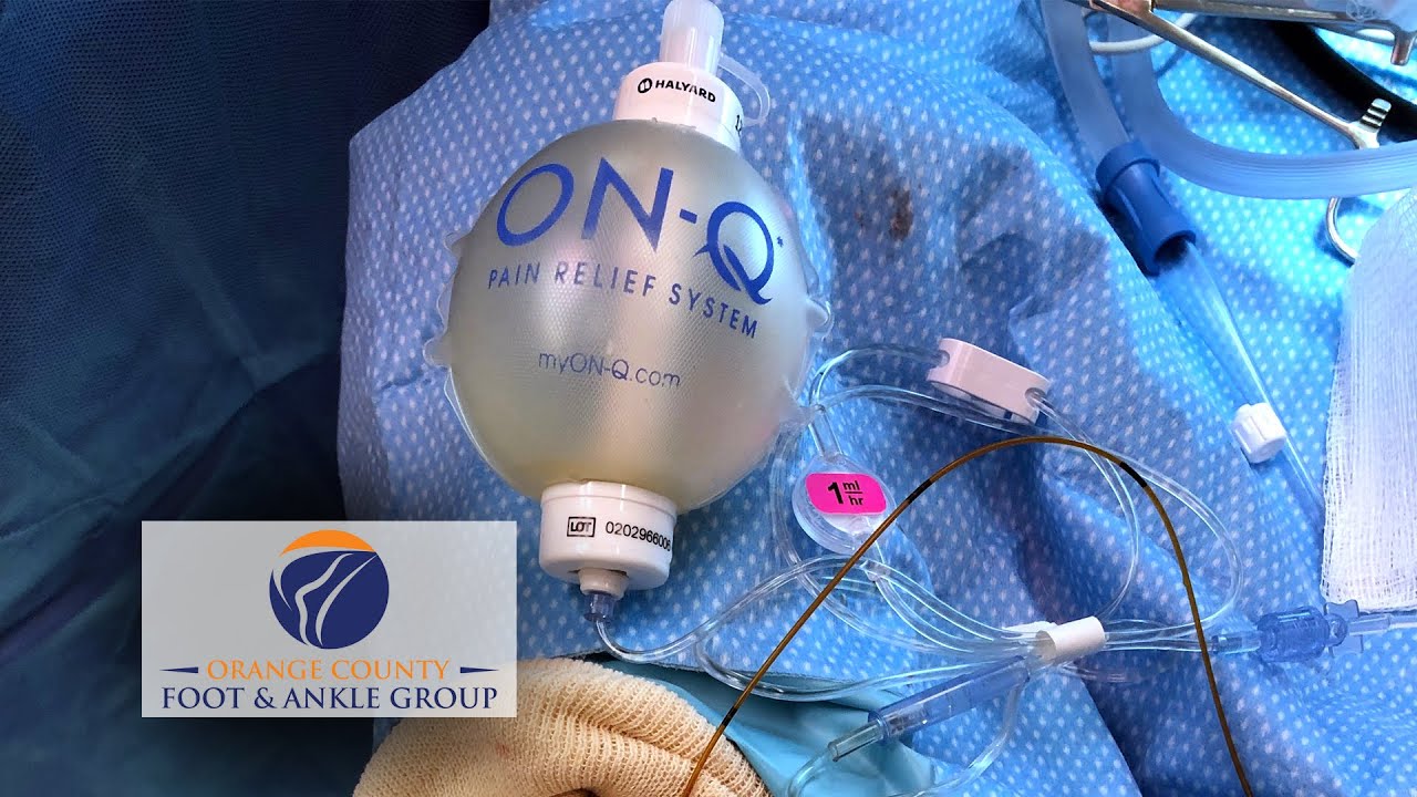 The ON Q Infusion Pain Pump for Regional Anesthesia Pain