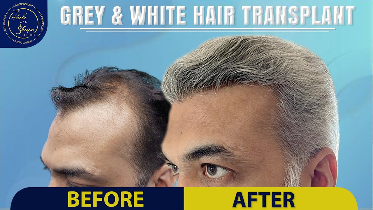 Grey And White Hair Transplant Result || HAIR AND SHAPE CLINIC || MUMBAI