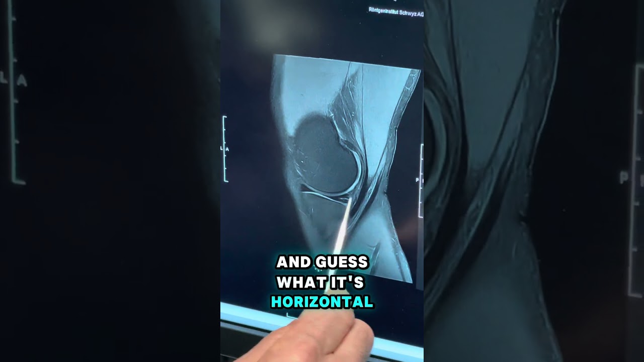 What is a horizontal meniscus tear? ￼