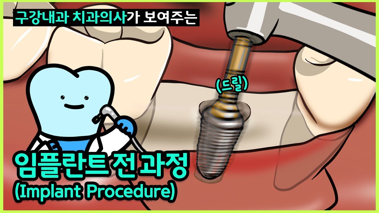 임플란트 과정, 임플란트수술 한국인이 좋아하는 속도로 (Implant procedure, Implant surgery, 임플란트 식립, 임플란트 전 과정 종류와 기구까지)