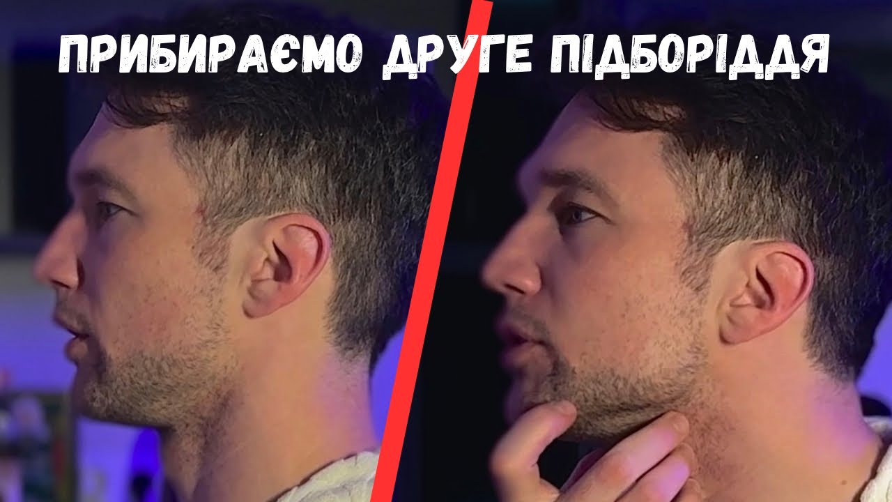 ВПРАВИ ДЛЯ ГАРНОГО ПРИКУСУ ТА ЛІНІЇ ЩЕЛЕПИ/ Від другого підборіддя. Реабілітація СНЩС. Брекети